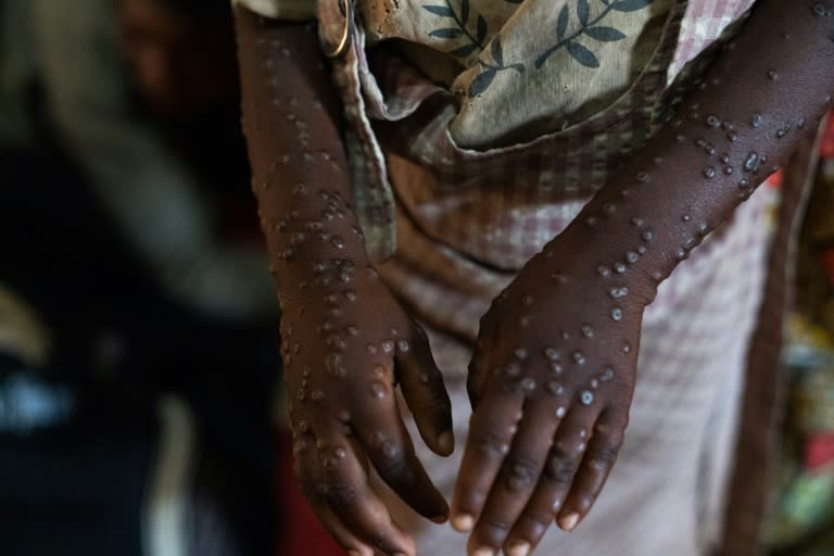 Mpox causes fever, muscular aches and large boil-like skin lesions and can be deadly in some cases (Glody MURHABAZI)