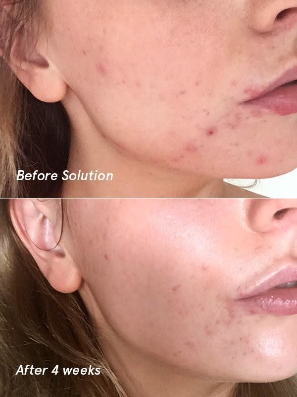 A before/after of a model with reduced acne and more glowing skin