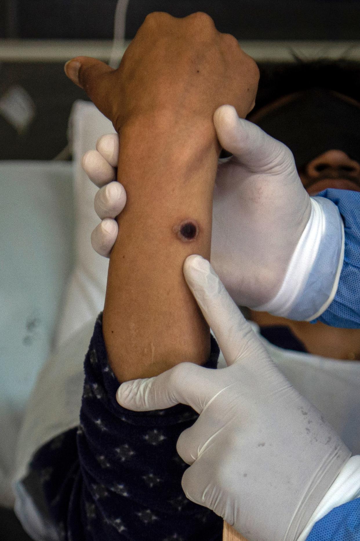 A doctor shows a patient that has a Mpox skin lesion.