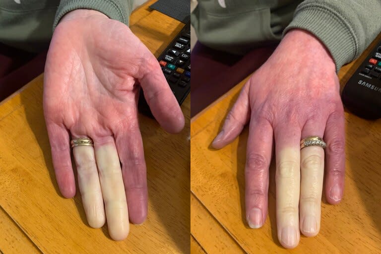 Los dedos de una mujer irlandesa que sufre síndrome de Raynaud se volvieron virales el año pasado