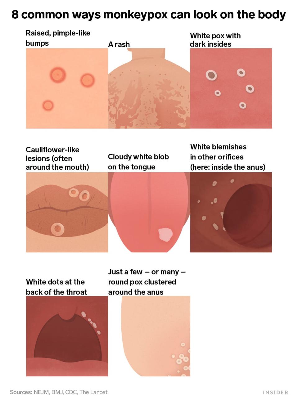 8 common ways monkeypox can look on the body: raised, pimple-like bumps, a rash, white pox with dark insides, cauliflower-like lesions (often around the mouth), cloudy white blob on the tongue, white blemishes in other orifices, white dots at the back of the throat, just a few or many round pox clustered around the anus.