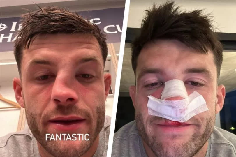 Blair Kinghorn posted a photo of his nose after Toulouse's Champions Cup clash win over Harlequins -Credit:Instagram/Blair Kinghorn