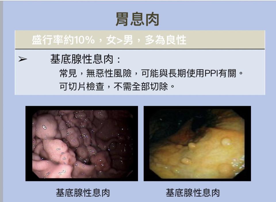 九成胃息肉都是屬於良性的胃底腺息肉。（圖：台安醫院蘇志盛醫師提供）