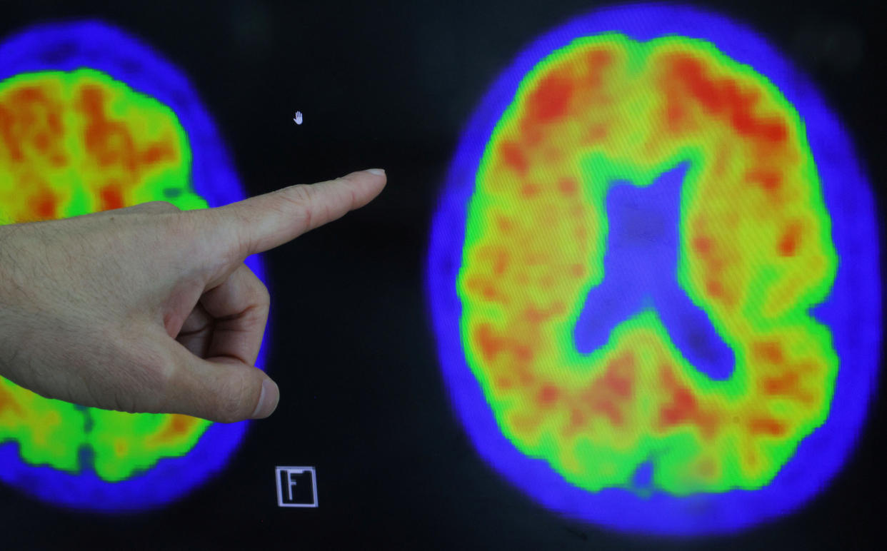 Dr. Seth Gale points out evidence of Alzheimer’s disease on PET scans at the Center for Alzheimer Research and Treatment (CART) at Brigham And Women’s Hospital in Boston, Massachusetts, U.S., March 30, 2023.     REUTERS/Brian Snyder