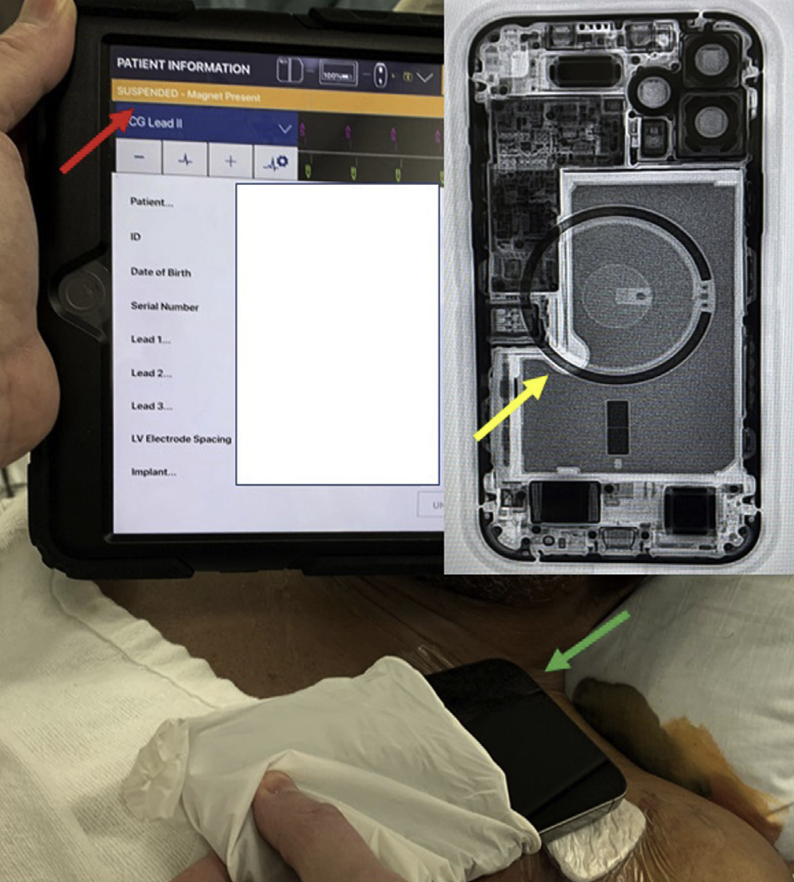 Device programmer showing suspension of implantable cardioverter-defibrillator therapy. Source: HeartRhythm 