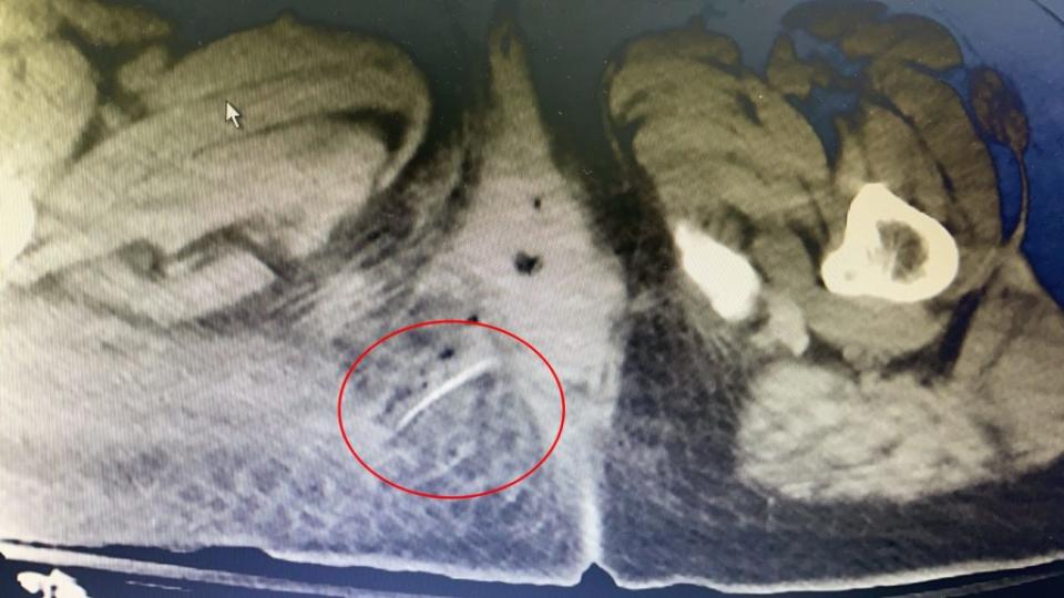 電腦斷層掃描江姓婦人右臀靠近肛門口處（箭頭處）可見魚刺。　（記者王正平翻攝）