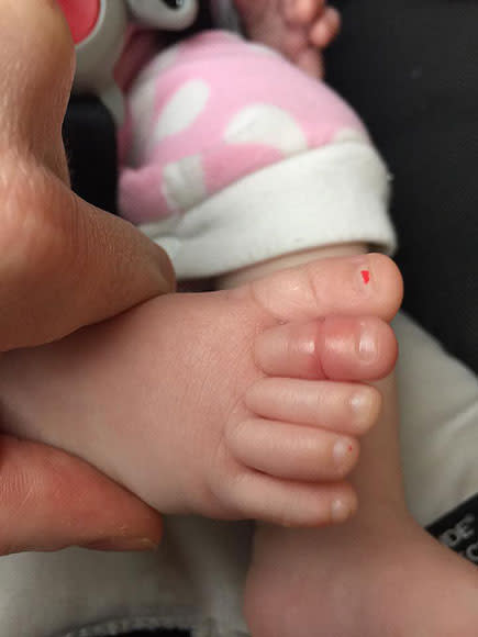 Father Warns Parents About Toe-Tourniquet Syndrome, Shares Dramatic Photo of His Baby Daughter's Injured Digit| Health, Kids and Family, Real People Stories