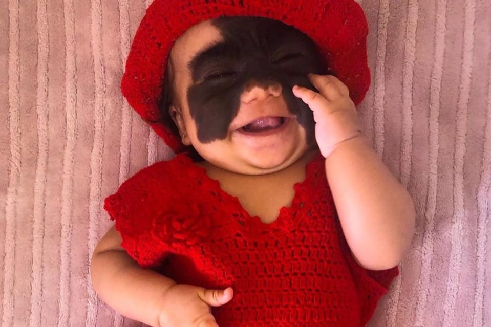 Baby Born with Rare Skin Condition Will Have Batman-Shaped Face Patch Removed