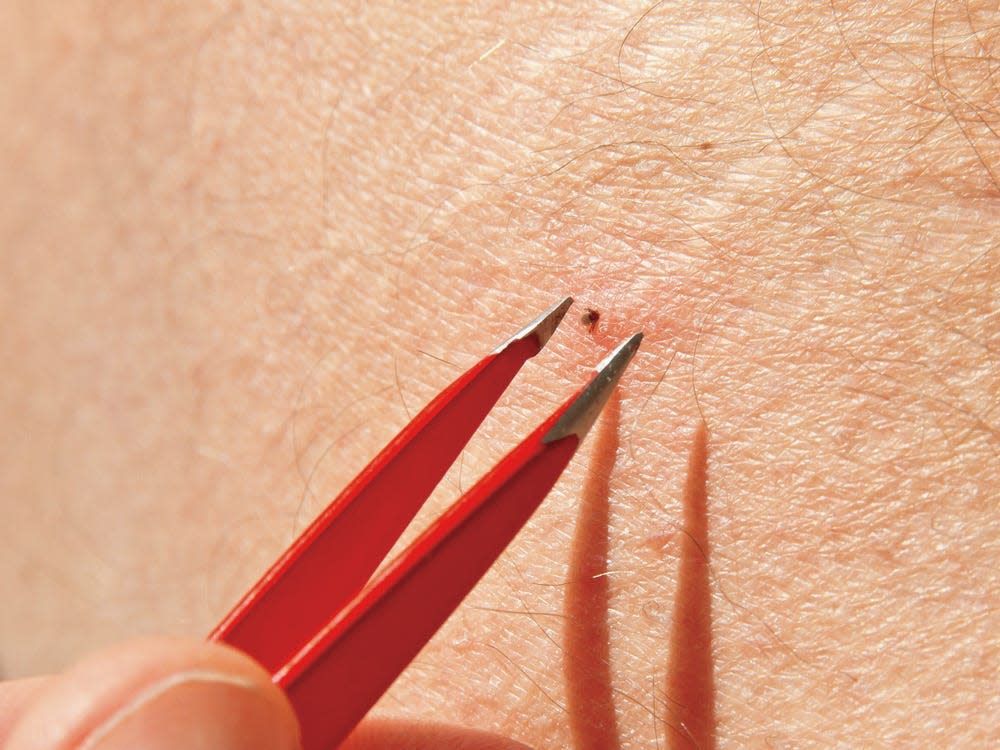 tweezers tick bite