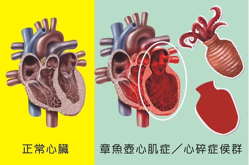 ▲患者左心室呈現章魚弧形狀（右圖），疑似「章魚壺心肌症」或稱「心碎症侯群」。（彰基提供）