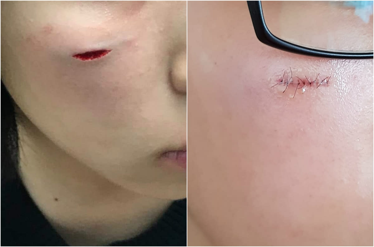 Goh's 14-year-old niece sustained a deep cut on her face that required nine stitches while playing at the mirror maze attraction at Jewel Changi Airport’s Canopy Park on 19 June, 2019. (PHOTOS: Susan Goh/Facebook)