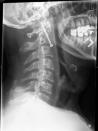 This X-ray released by New York's Montefiore Medical Center, Monday, July 16, 2007, shows a screw that was inserted in the broken neck of Paul Robinson, of Kirkland, Wash. Robinson, 53, was in the steep upper deck of Yankee Stadium with his wife and son July 8, 2007, when an unidentified man above him fell down several rows of seats, breaking Robinson's vertebra. (AP Photo/Montefiore Medical Center)