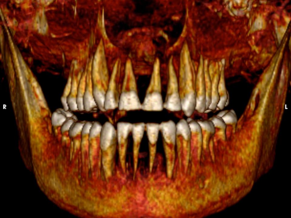 A 3D reconstitutions provides a view of Amenhotep's teeth.