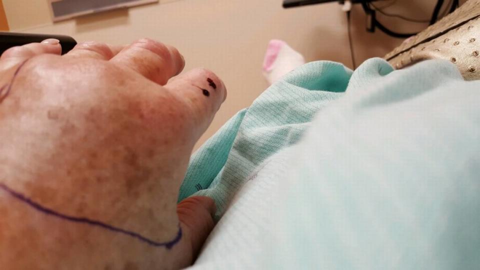 At Hilton Head Island Hospital, the black line on her hand was used to measure swelling over time from the copperhead snakebite on Carolyn Bivens Cote’s left index finger.