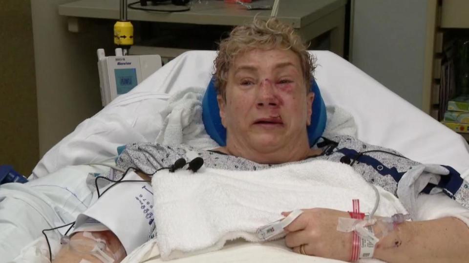 PHOTO: Lee Ann Galante was attacked by a bear in Butler Cunty, Pa., March 5, 2024. (WTAE)