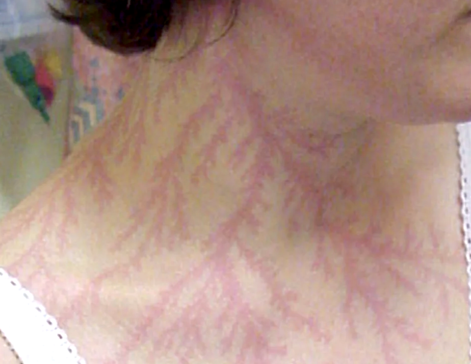 Close-up of a person's neck showing a red rash pattern that looks like tree branches, aka Lichtenberg figures