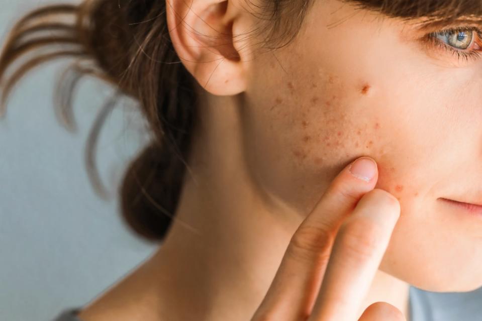 If you have a pimple that won’t heal after a couple of weeks, docs say it’s time to get it checked out. Katarina – stock.adobe.com