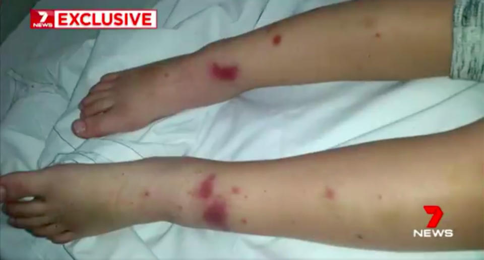 It took just hours for this rash to develop on five-year-old Dale Hayward’s legs. Source: 7News