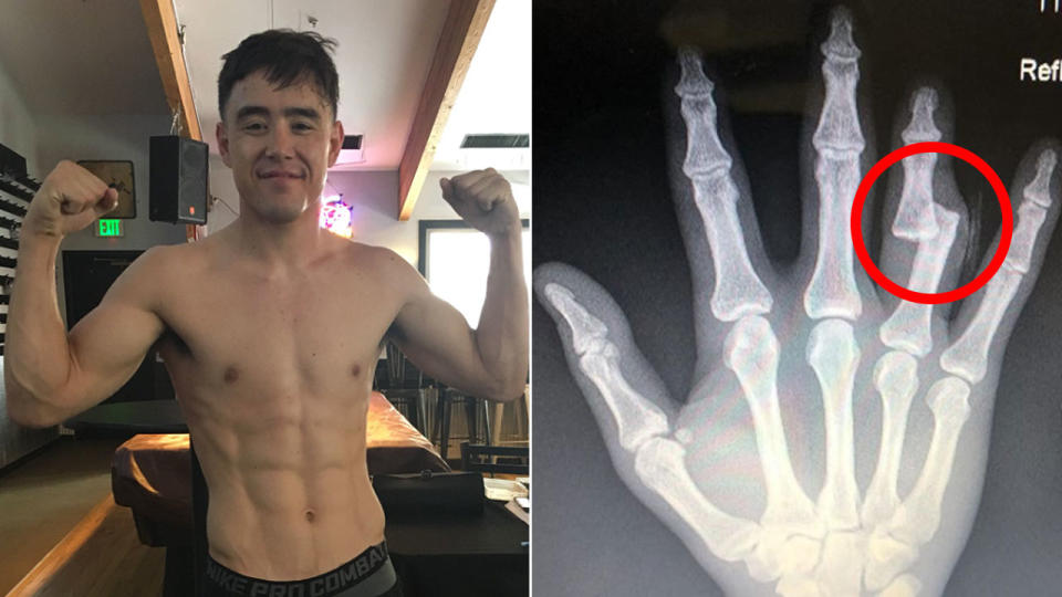 Park reveals the true extent of his injury. Pic: @HarveyParkMMA