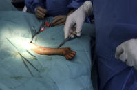 In this photo taken on Sunday, March 17, 2019, a veterinarian conducts a surgery on a three-month old baby orangutan named 'Brenda' that was evacuated from a village with a broken arm, at Sumatra Orangutan Conservation Programme (SOCP) facility in Sibolangit, North Sumatra, Indonesia. Orangutan populations in Indonesia's Borneo and Sumatra island are facing severe threats from habitat loss, illegal logging, fires and poaching. Conservationists predicted that without immediate action, orangutans are likely to be the first great ape to become extinct in the wild. (AP Photo/Binsar Bakkara)