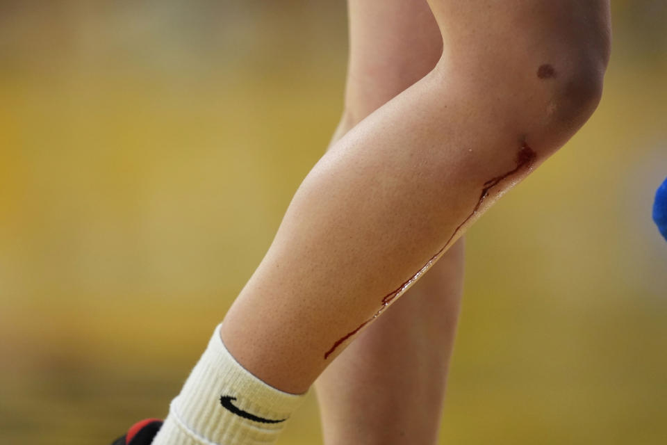 Iowa guard Caitlin Clark's bloody leg is seen in the second half of a second-round college basketball game against West Virginia in the NCAA Tournament, Monday, March 25, 2024, in Iowa City, Iowa. Iowa won 64-54. (AP Photo/Charlie Neibergall)