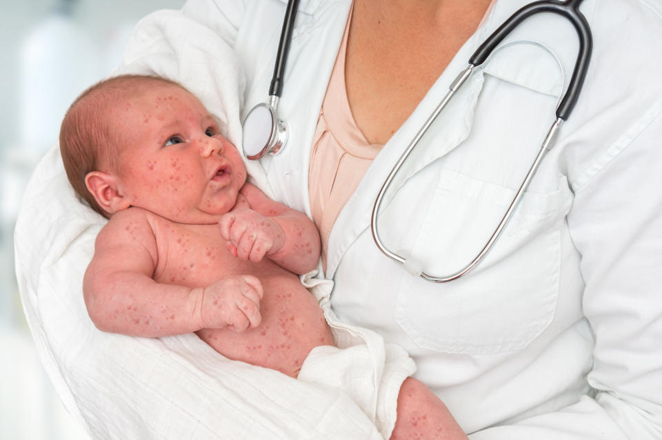 Doctor with stethoscope holding a newborn baby which is sick rubella or measles