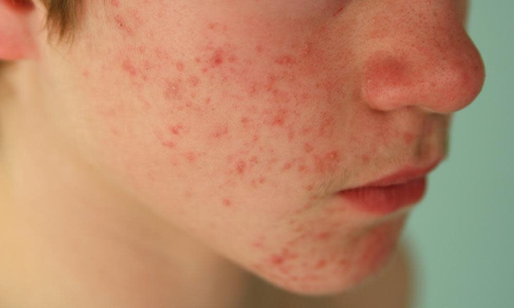 Pre-teen boy suffering from Acne