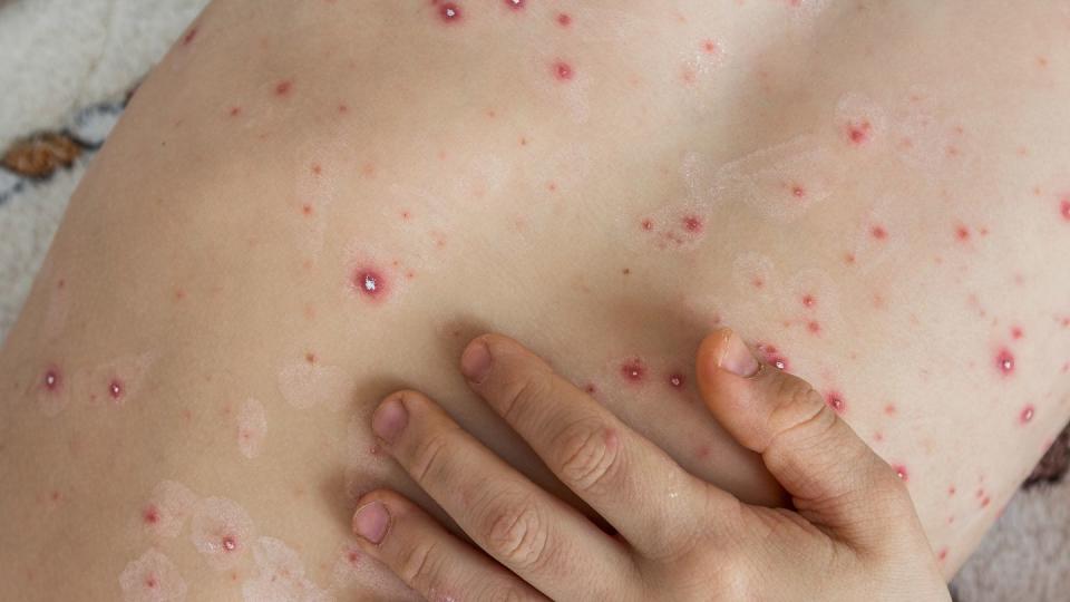 part of child's body with chickenpox bubbles