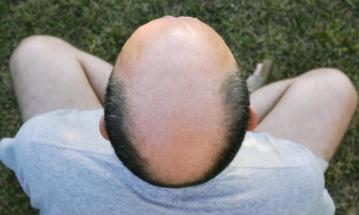 <span>The hair-loss treatment industry survives by making people feel bad about themselves.</span><span>Photograph: Maica/Getty Images/iStockphoto</span>