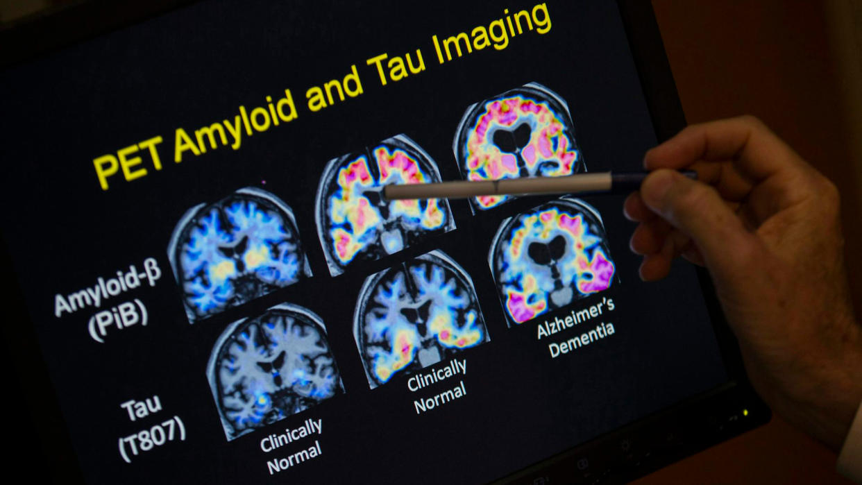  Close up on a person's hand as they use a pen to point at an image of 6 brain scans, labeled "PET amyloid and tau imaging". 