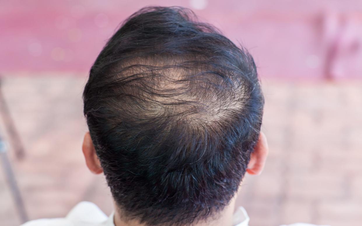 Hair loss