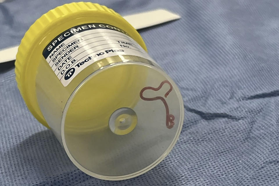 This undated photo supplied by Canberra Health Services, shows a parasite in a specimen jar at a Canberra hospital in Australia. A neurosurgeon investigating a patient's mystery neurological symptoms in an Australian hospital has been surprised to pluck a 3-inch wriggling worm from her brain. (Canberra Health Services via AP)