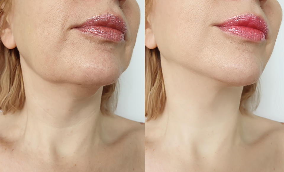 Neck-Lift-Before-and-After-Stock-Photo