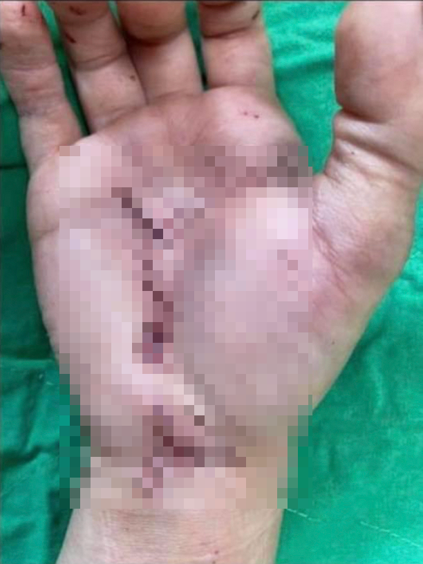 護理師手部被砍傷。（圖／翻攝自醫護大小事Facebook）