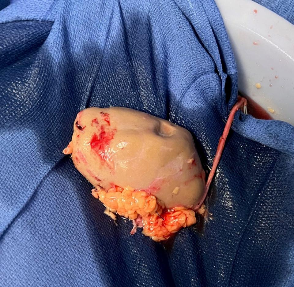 One of Kevin Kiernan's kidneys shortly after it was surgically removed from his body in January 2023 to be transplanted to a friend.