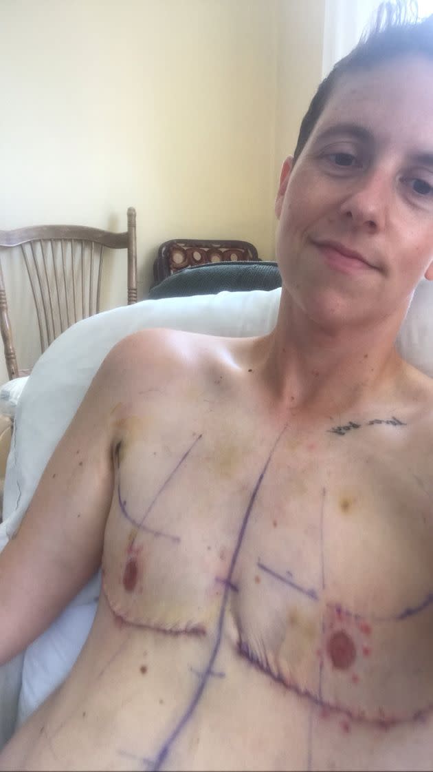 The author after their top surgery. (Photo: Courtesy of Jaime Lazich)