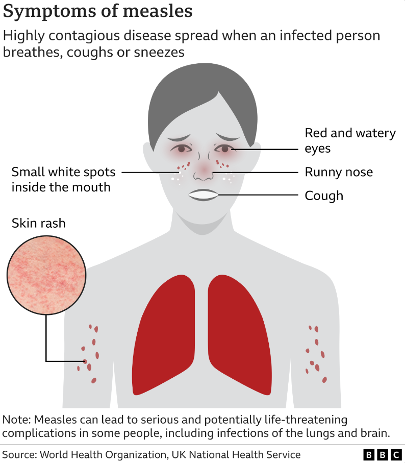 Measles symptoms