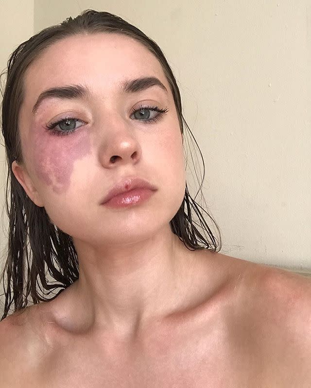 Sarah Taylor's love and acceptance of her rare birthmark is helping others see their own unique beauty. (Photo: Instagram/sruhtaylor)