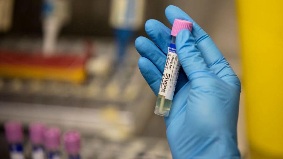 <div>MADRID, SPAIN - JUNE 06: A medical laboratory technician shows a suspected monkeypox sample at the microbiology laboratory of La Paz Hospital on June 06, 2022 in Madrid, Spain. Europe is at the centre of the monkeypox virus outbreak, the World Health Organisation reported 780 confirmed cases with Britain, Spain and Portugal reporting the largest numbers of patients. (Photo by Pablo Blazquez Dominguez/Getty Images)</div>