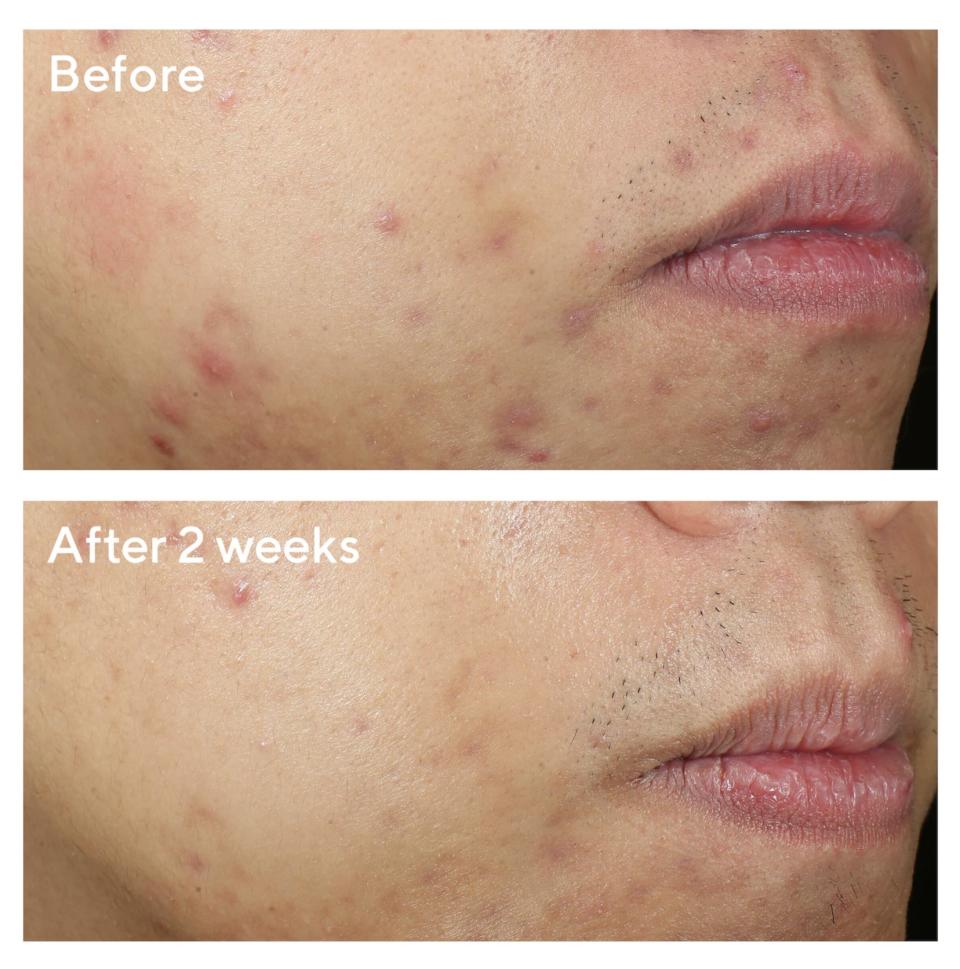 Close-up of a person's cheek and lips showing acne treatment results: 'Before' with acne, 'After 2 weeks' clearer skin