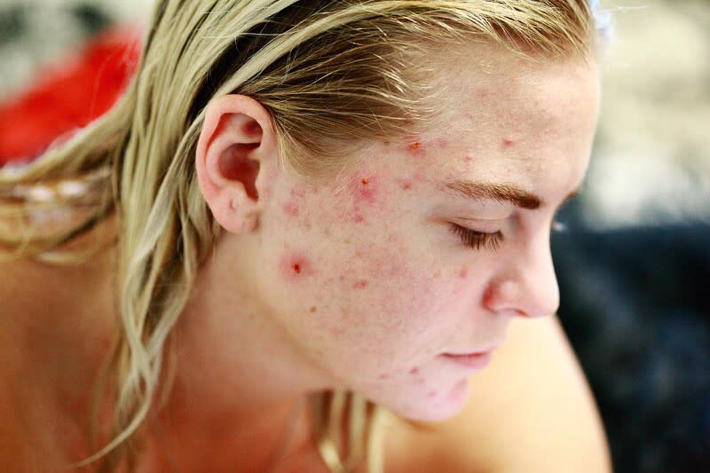 粉刺和痘痘會冒出來，則是因為肌膚正在代謝的緣故，屬於正常現象
