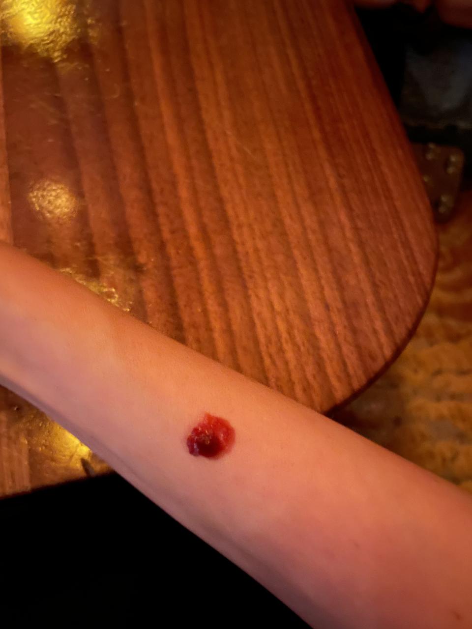 Lara's arm with ketchup