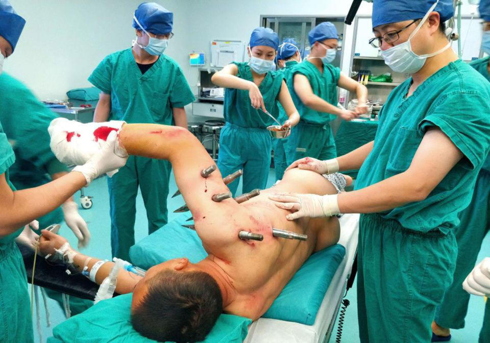 Mr Zhou was impaled by 10 spikes after a robotic arm collapsed on him at a porcelain factory in Hunan, China. Source: Australscope/Shutterstock