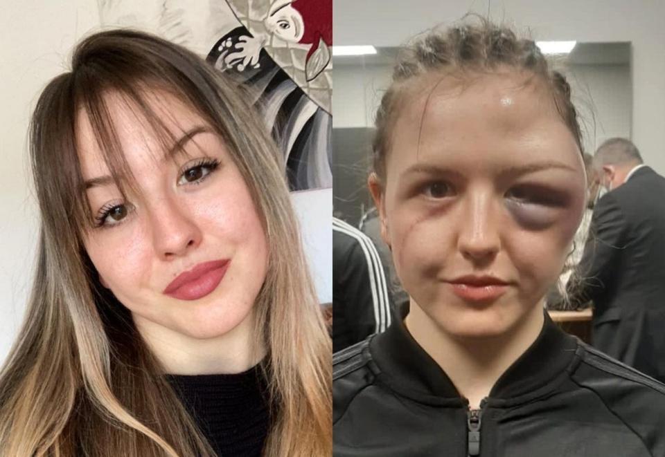 El antes y el después del rostro de la boxeadora Cheyenne Hanson tras una pelea. (Foto: Instagram / @cheyenne_hanson_boxing).