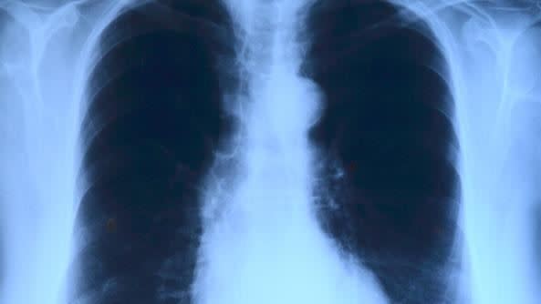 21歲男大生胸痛就醫，照X光肺部一片白，後續檢查發現縱膈腔長了一個15公分大的腫瘤。（示意圖／Pixabay）