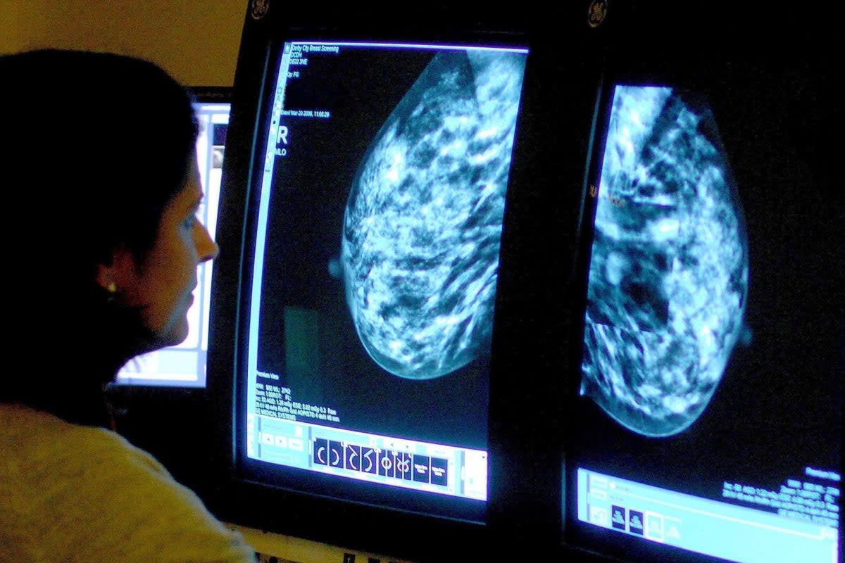 The majority of women who are diagnosed with early-stage breast cancer will become ‘long term survivors’, according to a study  (PA Wire)
