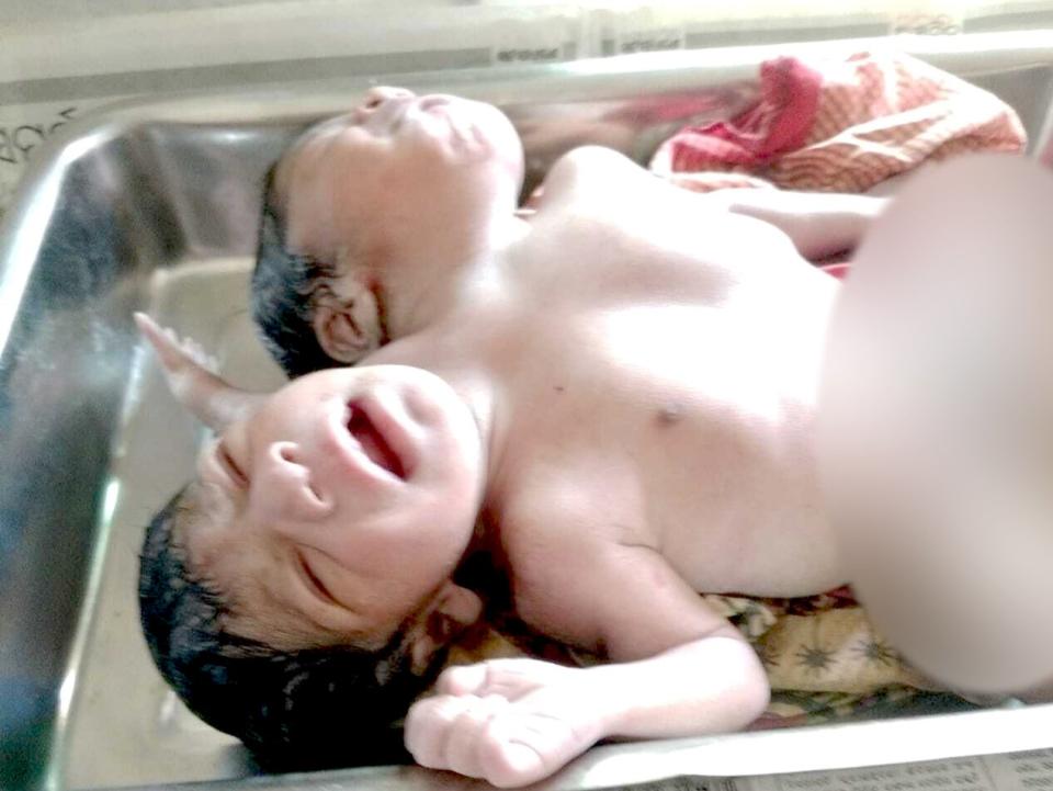 <p>Conjoined twins with two heads, three arms and a torso, were born in Odisha, India on 12 April</p> (Supplied by Pravat Kumr Parida)