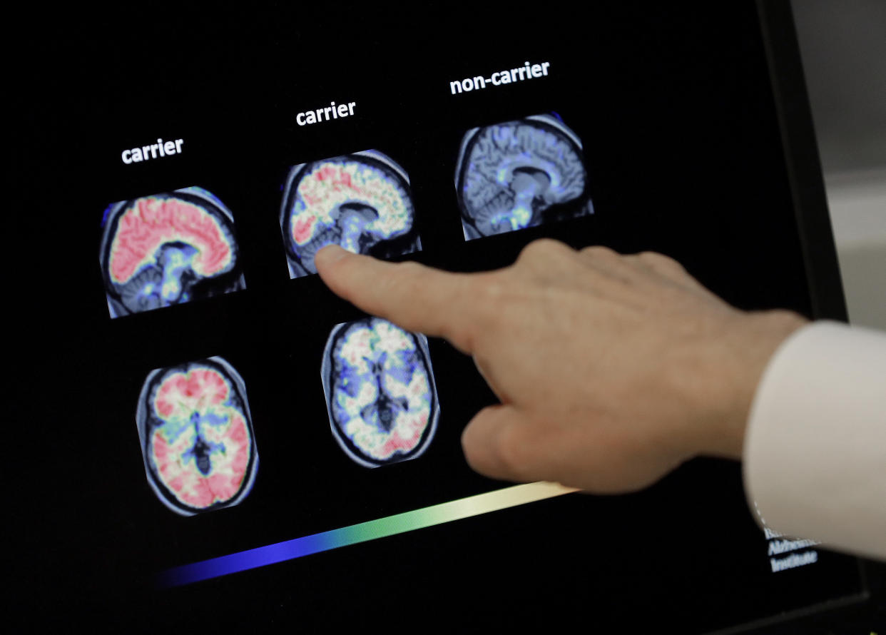 FILE - In this Aug. 14, 2018 file photo, Dr. William Burke goes over a PET brain scan at Banner Alzheimers Institute in Phoenix. The drug company Biogen Inc. says it will seek federal approval for a medicine to treat early Alzheimer's disease, a landmark step toward finding a treatment that can alter the course of the most common form of dementia.
The announcement Tuesday, Oct. 22, 2019, is a surprise because the company earlier this year stopped two studies of the drug, called aducanumab, after partial results suggested it was not working.  (AP Photo/Matt York, File)