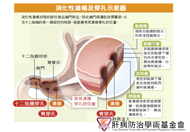 一般而言，輕微潰瘍不處理，多半也會自行痊癒，但仍有少部分病人，不積極治療，一旦攻擊因子越來越強，不僅是潰瘍，甚至還會有狹窄、穿孔、出血的可能。