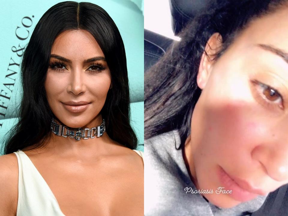 kim kardashian psoriasis instagram